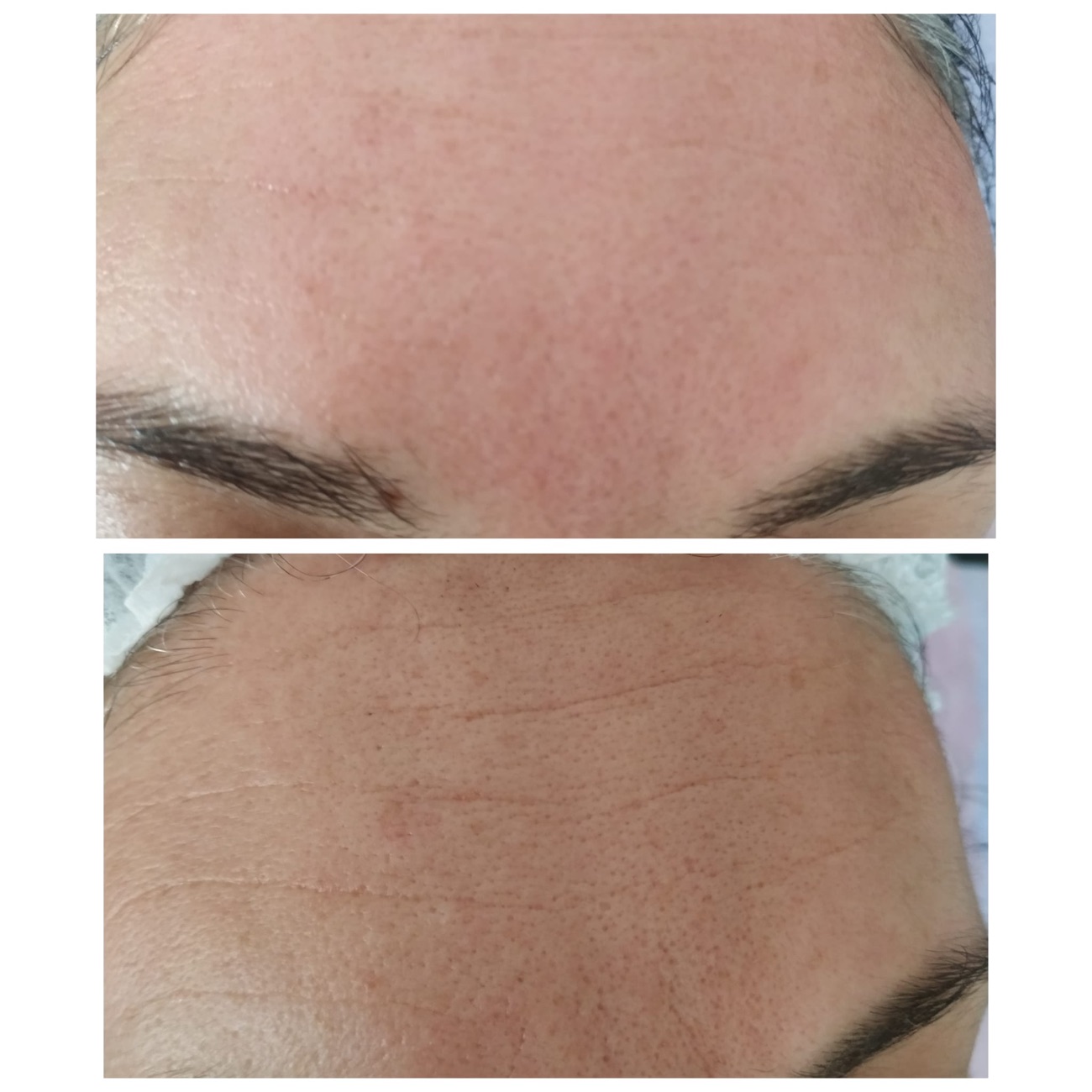 Tratamiento facial con dermapen antes y después