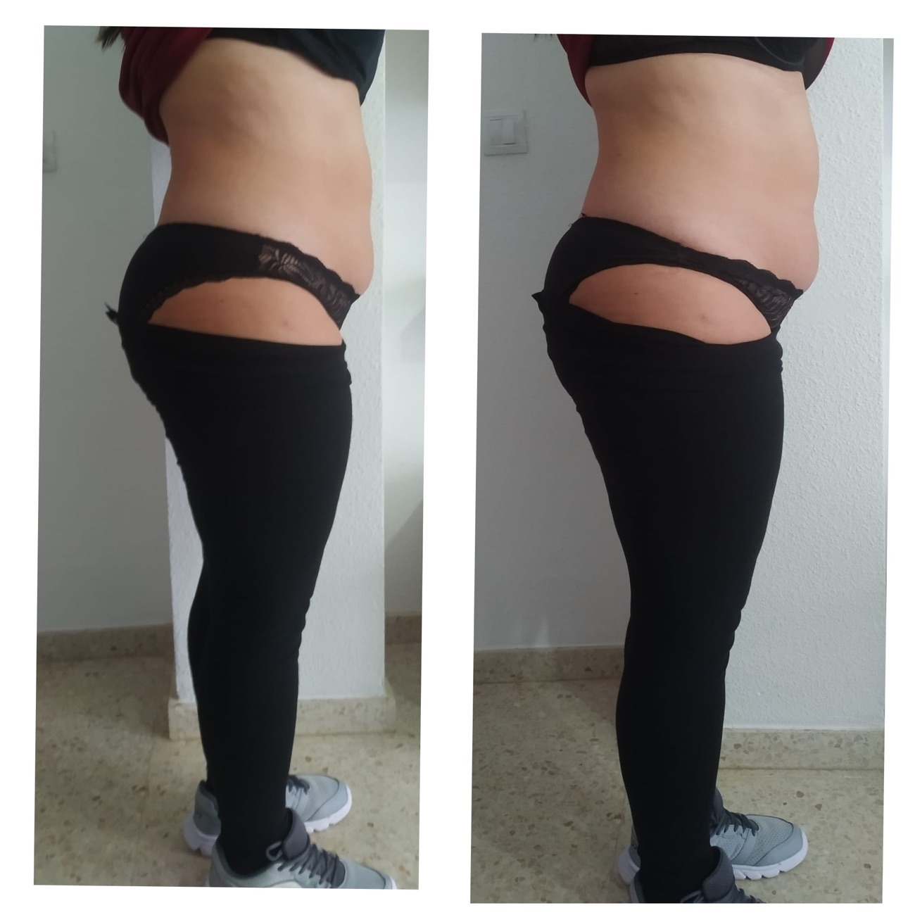 Reducción de volumen de perfil tras el tratamiento